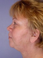 Facelift Before and after photo