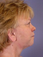 Facelift Before and after photo