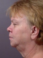 Facelift Before and after photo