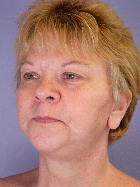 Facelift before and after photo