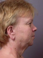 Facelift Before and after photo