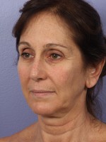 Facelift Before and after photo