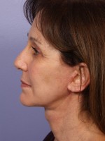 Facelift Before and after photo