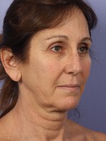 Facelift Before and after photo