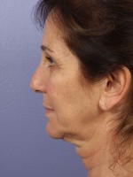 Facelift Before and after photo