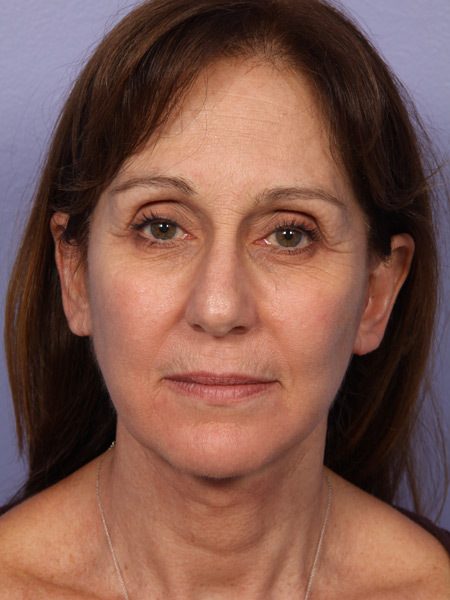 Facelift before and after photo