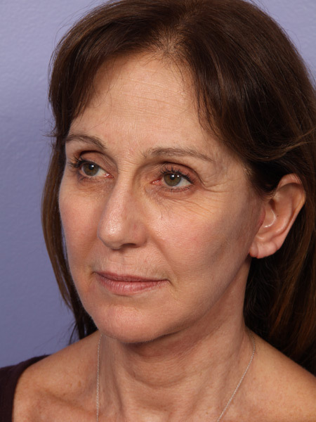 Facelift before and after photo