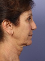 Facelift Before and after photo