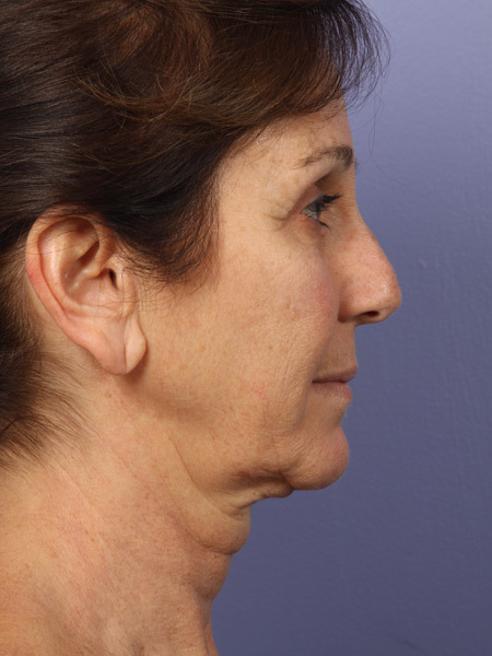 Facelift before and after photo