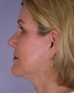 Facelift Before and after photo