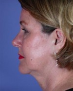 Facelift Before and after photo