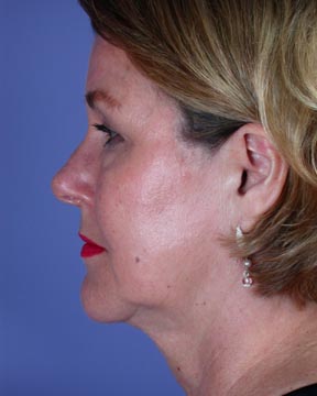 Facelift before and after photo