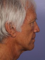 Facelift Before and after photo