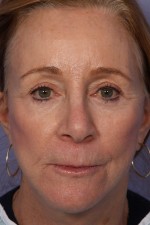 Facelift Before and after photo