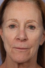 Facelift Before and after photo