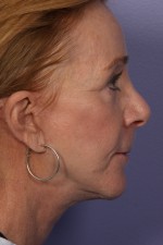 Facelift Before and after photo