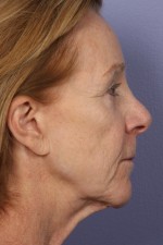 Facelift Before and after photo