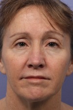 Facelift Before and after photo