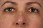 Injectable Fillers Before and after photo