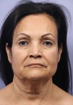 Facelift Before and after photo