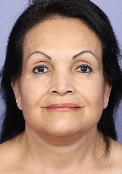 Facelift before and after photo