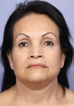 Facelift Before and after photo