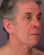 Facelift Before and after photo