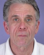 Facelift Before and after photo
