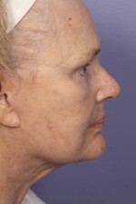 Facelift Before and after photo