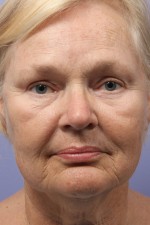 Facelift Before and after photo