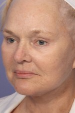 Facelift