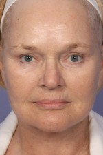 Facelift Before and after photo