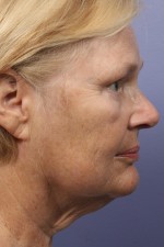 Facelift Before and after photo