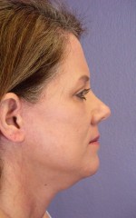 Facelift
