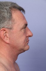 Facelift Before and after photo