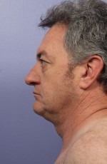 Facelift Before and after photo