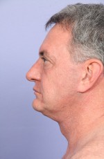 Facelift Before and after photo