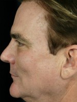 Laser Skin Resurfacing Before and after photo