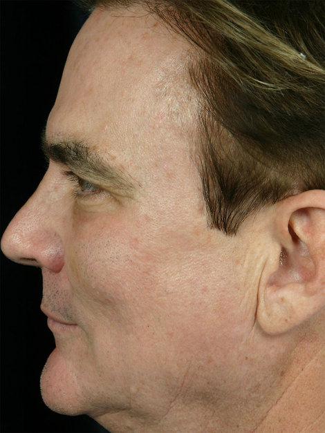 Laser Skin Resurfacing before and after photo