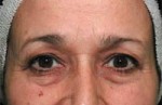 ThermaCool Non-Surgical Facelift Before and after photo