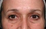 ThermaCool Non-Surgical Facelift Before and after photo