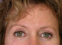 ThermaCool Non-Surgical Facelift before and after photo