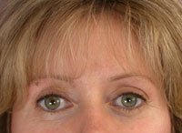 ThermaCool Non-Surgical Facelift before and after photo
