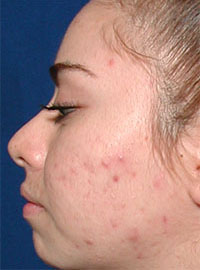 ThermaCool Non-Surgical Facelift before and after photo