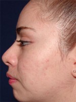 ThermaCool Non-Surgical Facelift