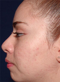 ThermaCool Non-Surgical Facelift before and after photo