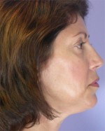 ThermaCool Non-Surgical Facelift