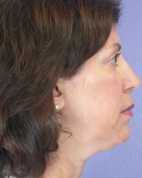 ThermaCool Non-Surgical Facelift before and after photo