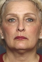 ThermaCool Non-Surgical Facelift Before and after photo