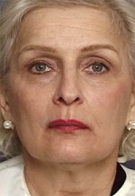 ThermaCool Non-Surgical Facelift